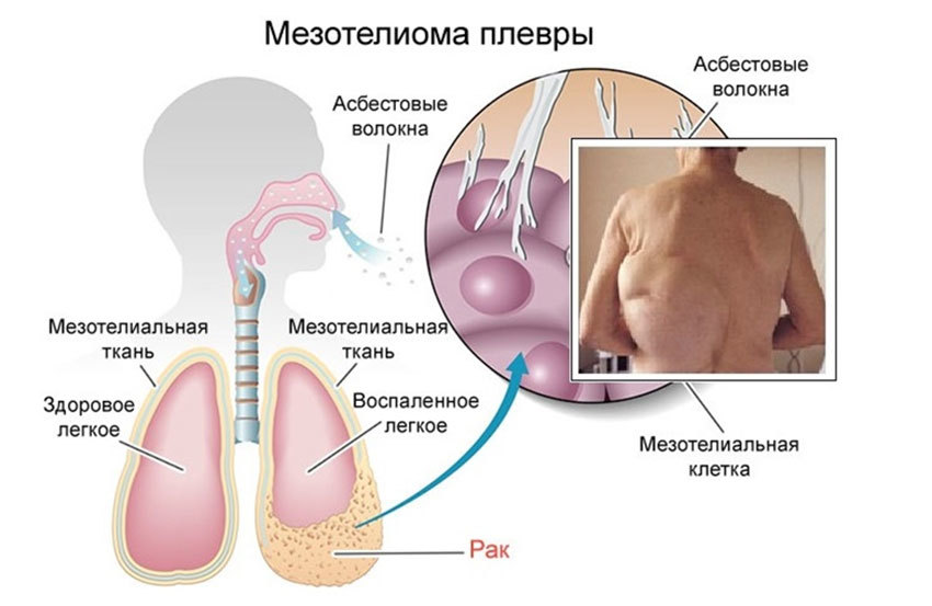 Мезотелиома плевры