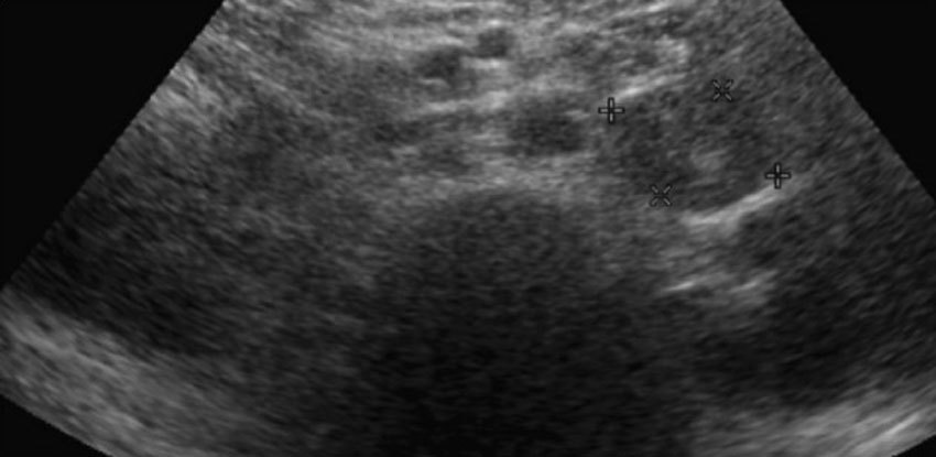 Метастазы в надпочечники