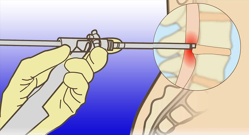 Эндоскопическая операция по удалению межпозвоночной грыжи