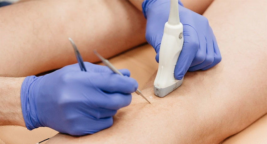 Выполнение минифлебэктомии в международной клинике Медика24