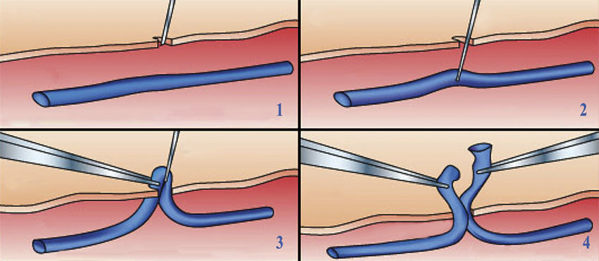 Минифлебэктомия в международной клинике Медика24