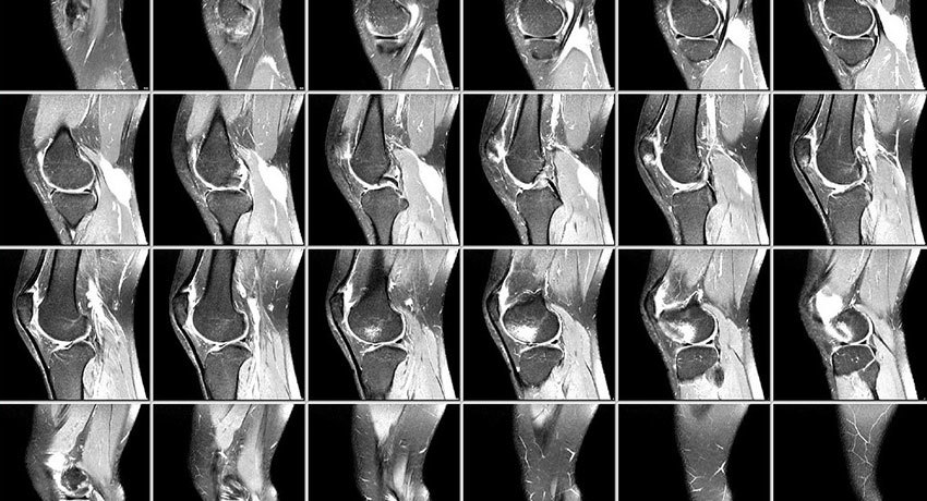 Снимок МРТ коленного сустава