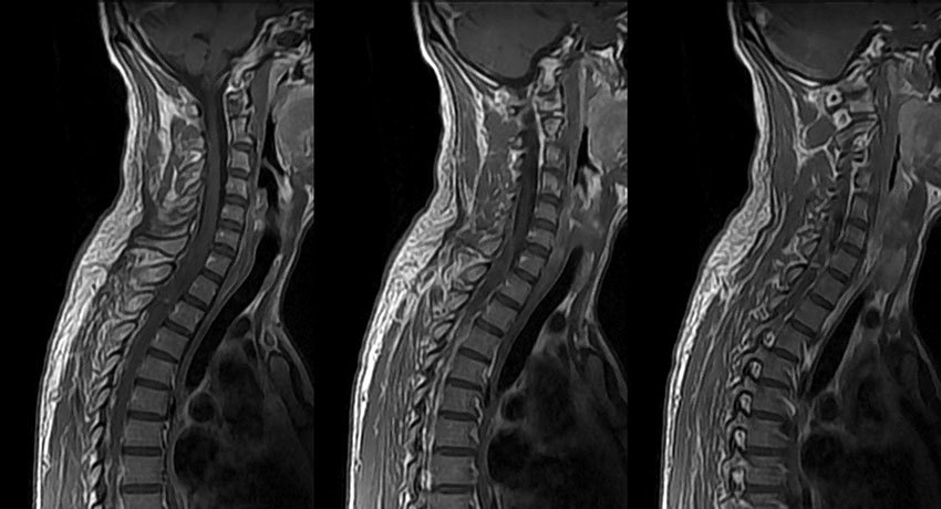 МРТ шейного отдела позвоночника