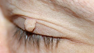 мягкие-фибромы