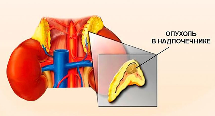 Опухоль надпочечника
