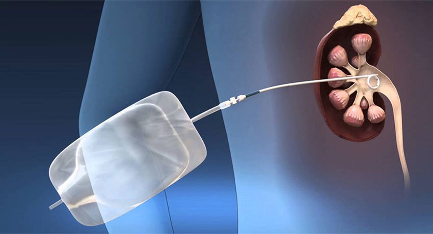 Нефростомия