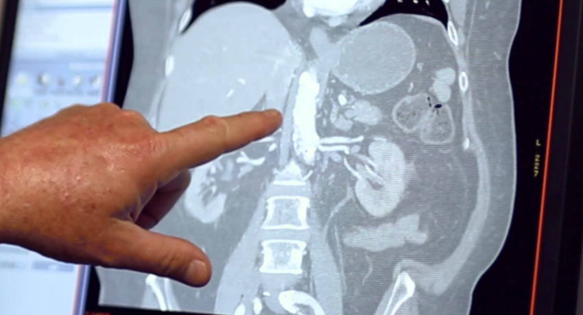 Нейроэндокринный рак печени