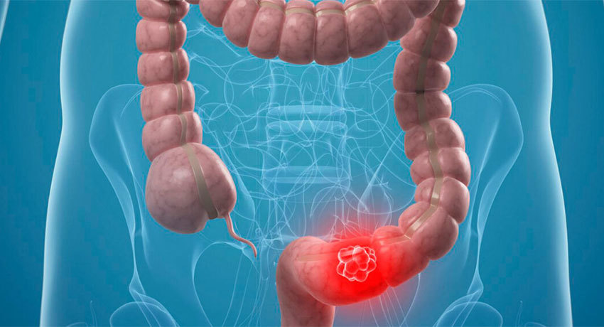 Лечение некроза кишечника в международной клинике Медика24