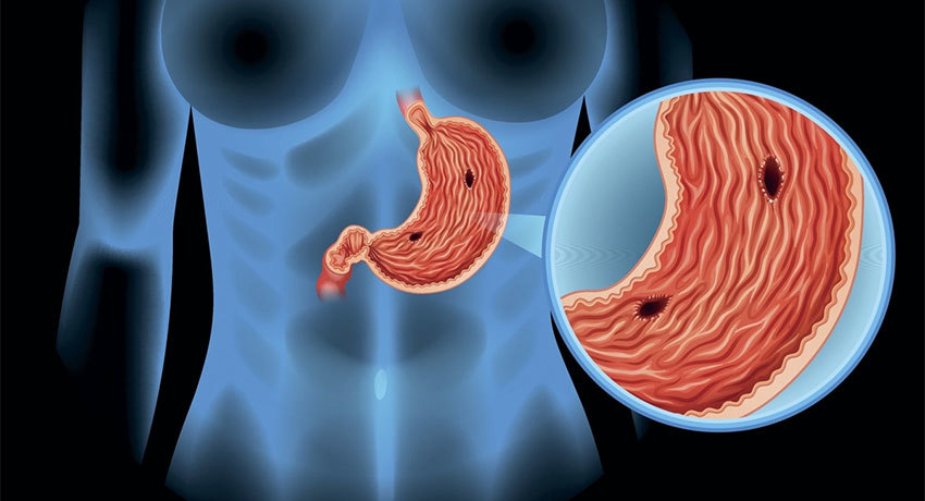 Перфорация желудка