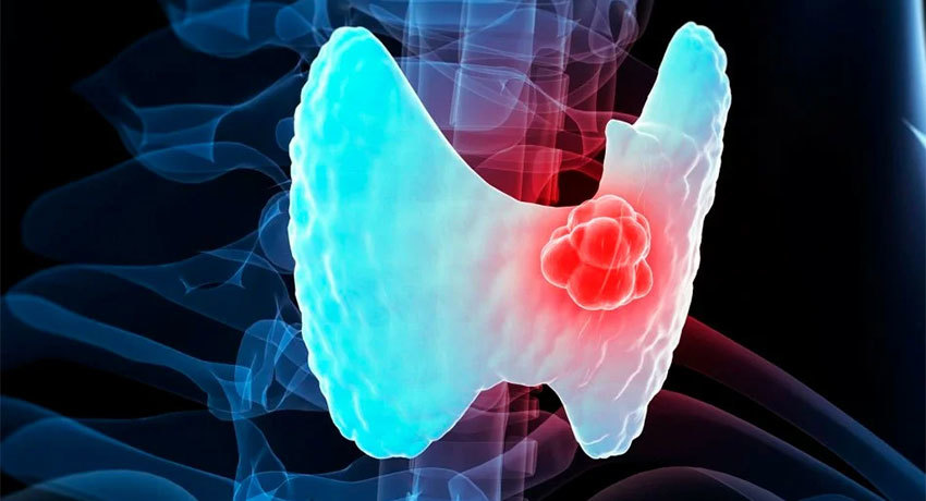 Рак щитовидной железы