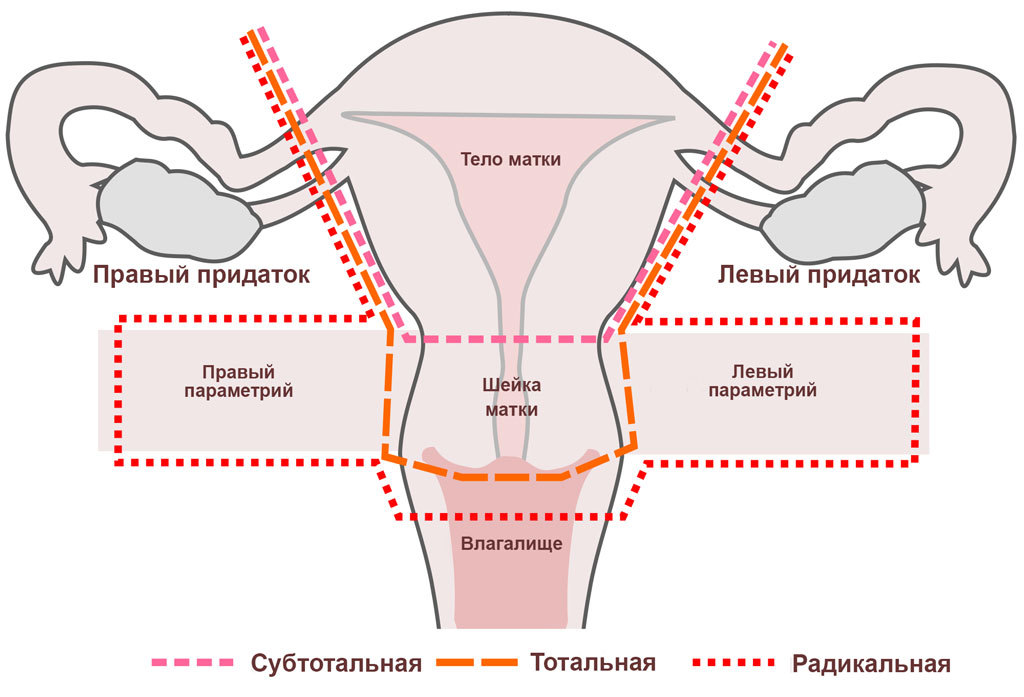 Операция Вертгейма