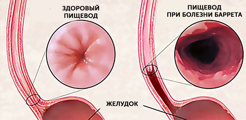 Оперативное лечение рефлюкс-эзофагита