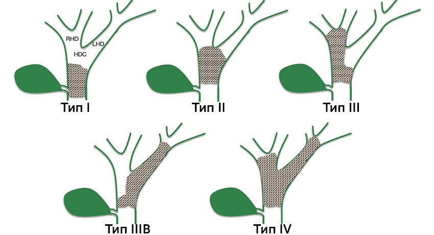 Типология опухоли Клацкина