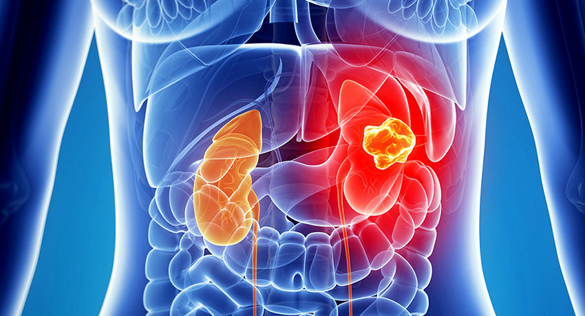 Операции при опухолях почки