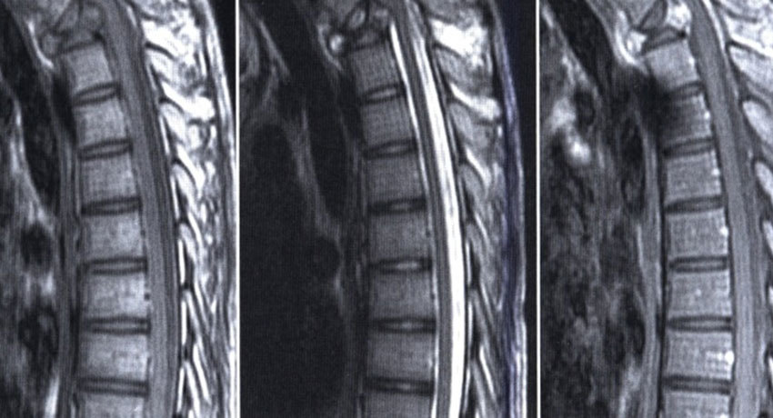 Остеосаркома позвоночника
