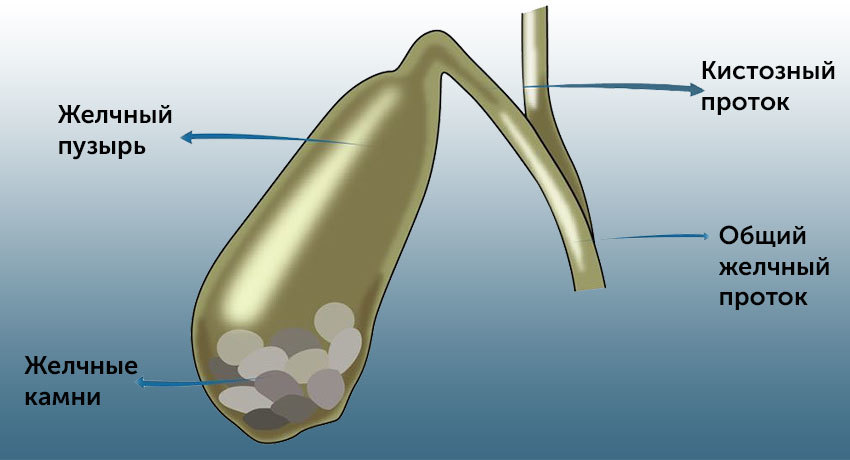 Острый калькулезный холецистит