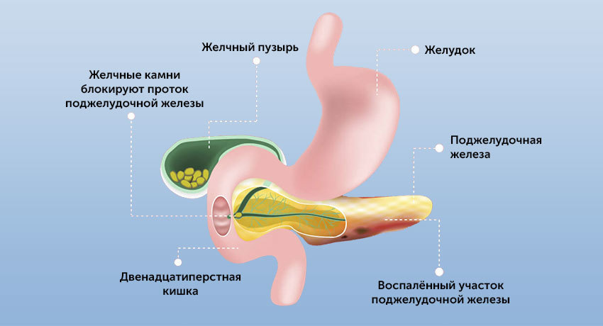 Причины острого панкреатита
