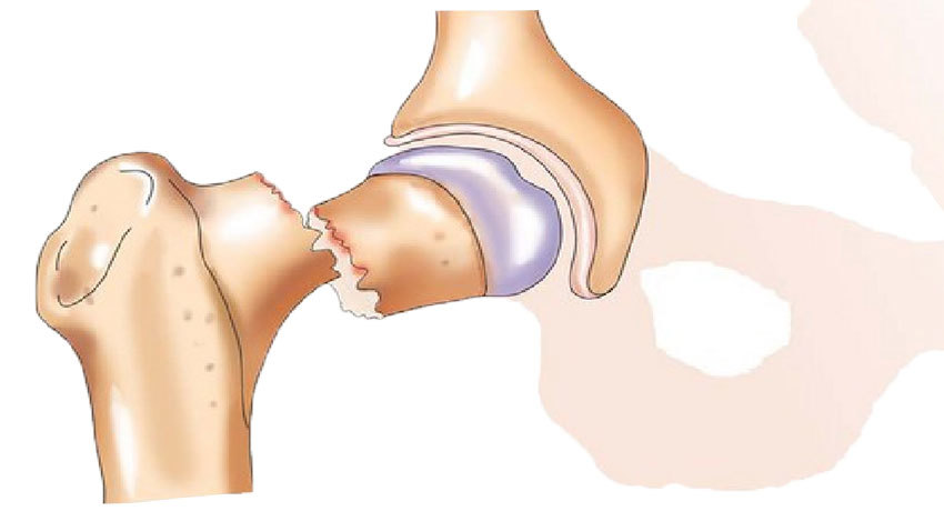 Патологический перелом шейки бедра