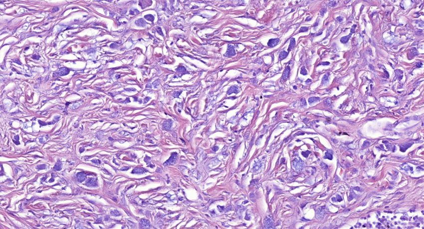 Перстневидноклеточный рак