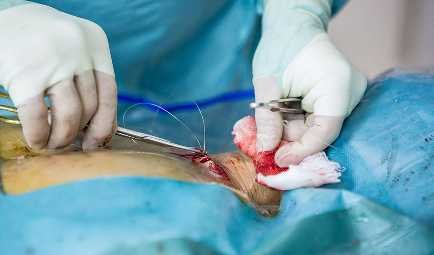 Операция заканчивается наложением одного шва.