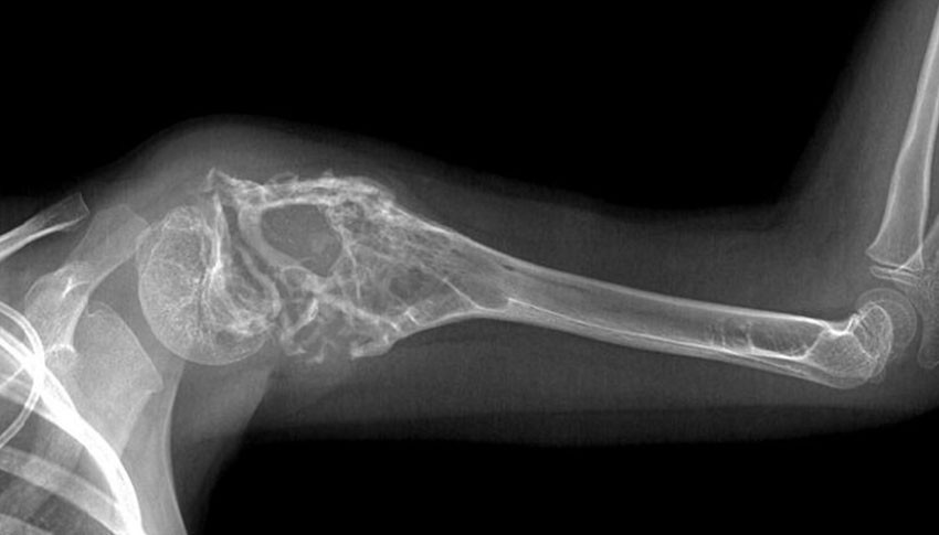 Рак кости на рентгеновском снимке