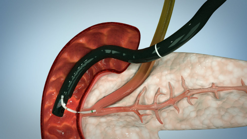 Стентирование желчного протока