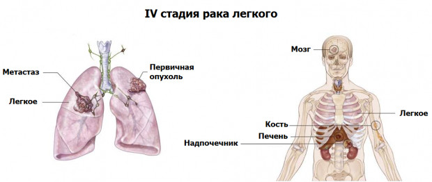 Рак легкого 4-я стадия
