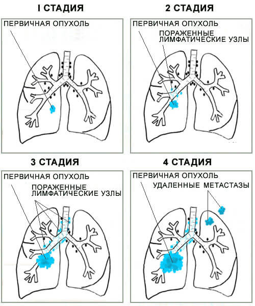 Стадии рака легких
