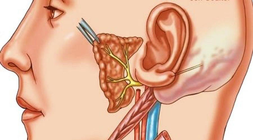 Неврит слухового нерва