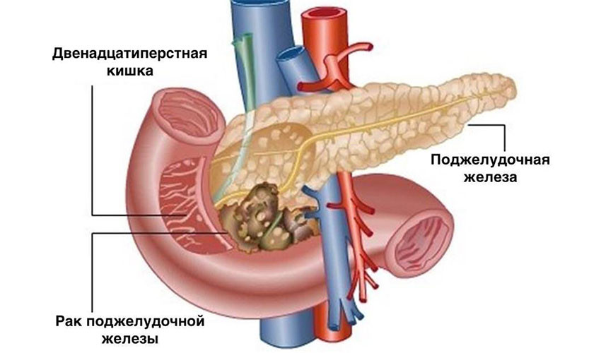Рак поджелудочной железы