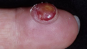 пиогенные-гранулемы