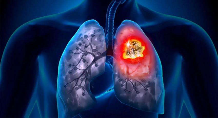 Показания для плевральной пункции