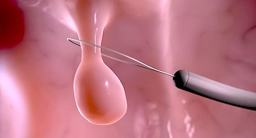 Удаление полипов