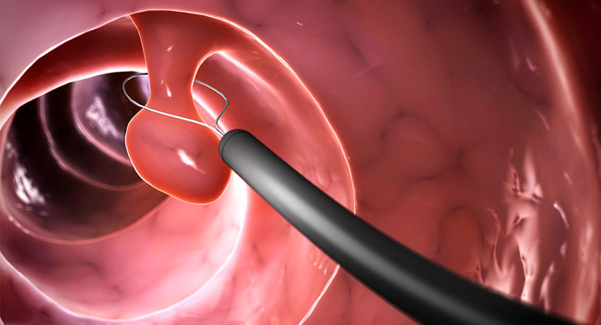Проведение полипэктомии