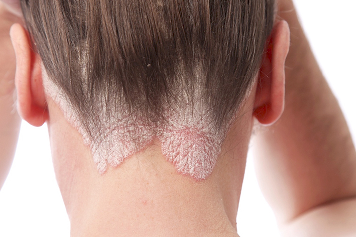 psoriaz-simpiom