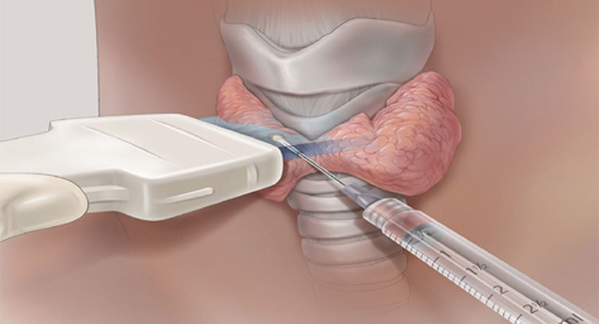 Пункция щитовидной железы