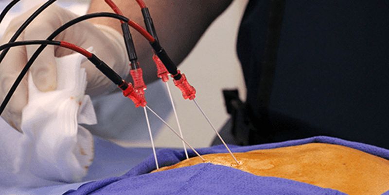 radiochastotnaja-abljacija