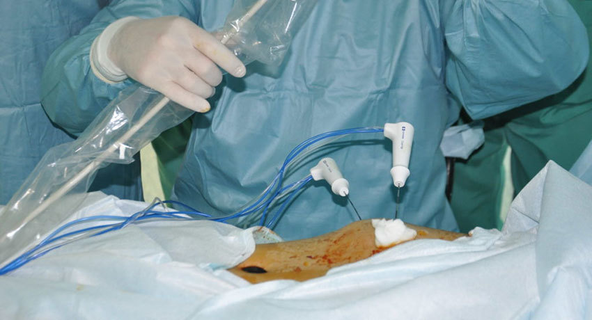 Проведение радиочастотной абляции