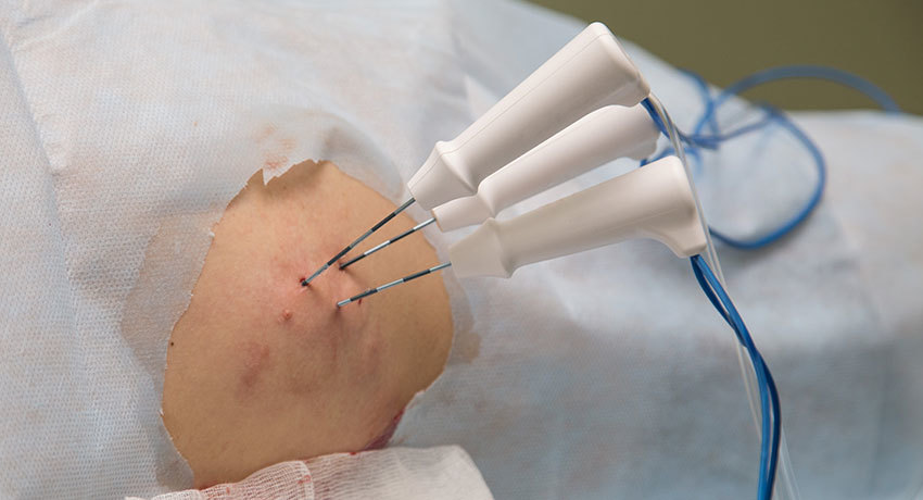 Радиочастотная абляция новообразований