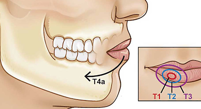 Рак губы с метастазами