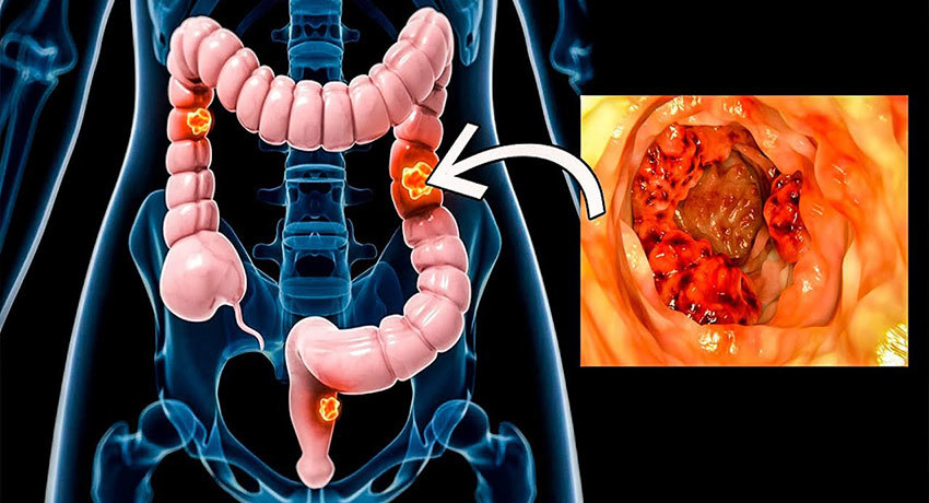 Рак кишечника