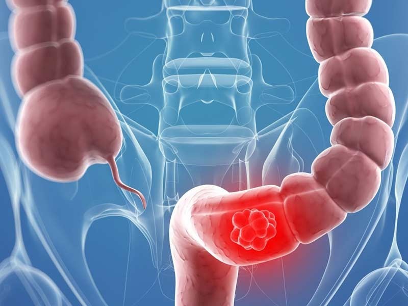 рак кишечника