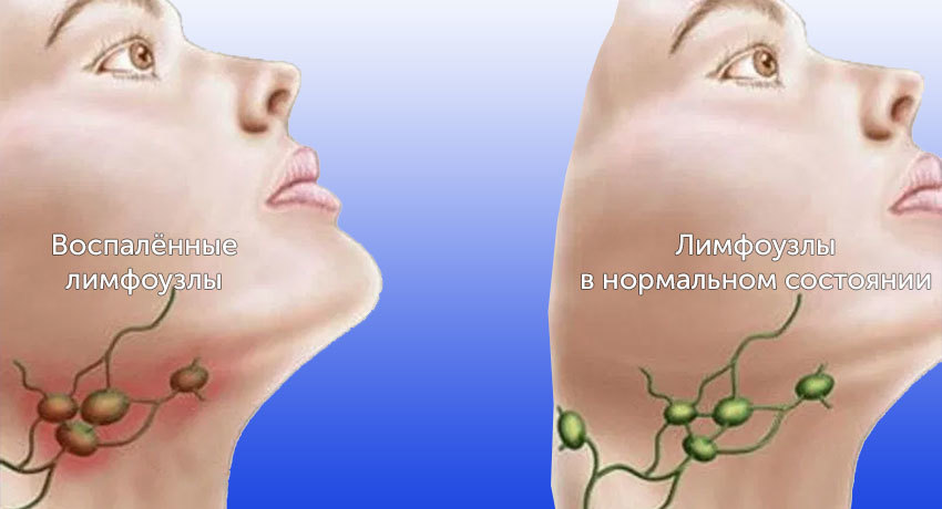 Увеличение лимфоузлов