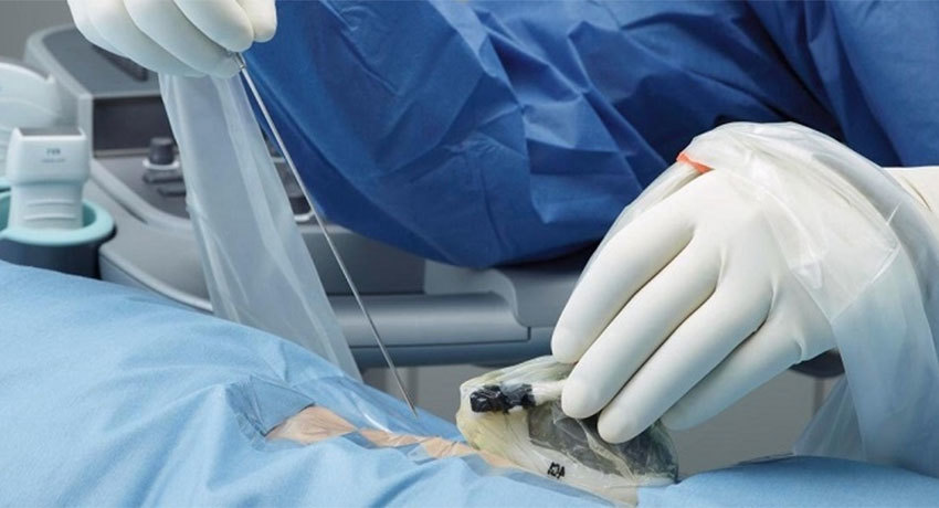 Биопсия легкого