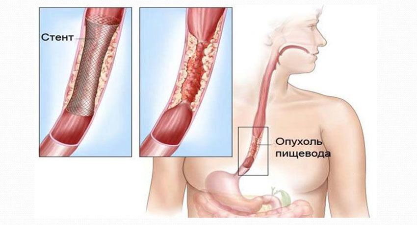 Стентирование пищевода в международной клинике Медика24