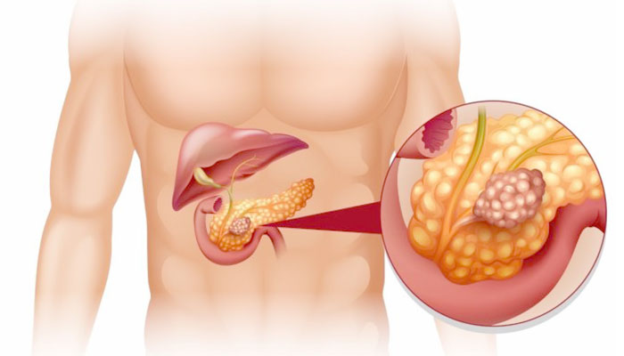 rak-podzheludochnoj-metastazy1