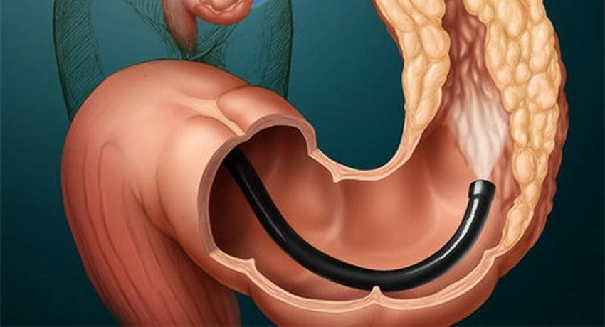 Проведение колоноскопии