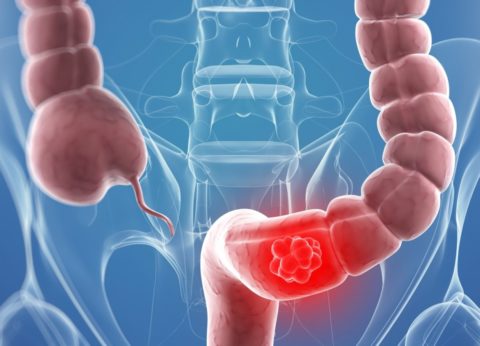 рак толстого кишечника