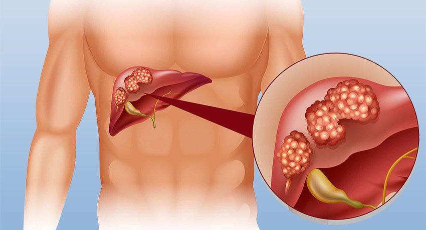 Поражение печени опухолью