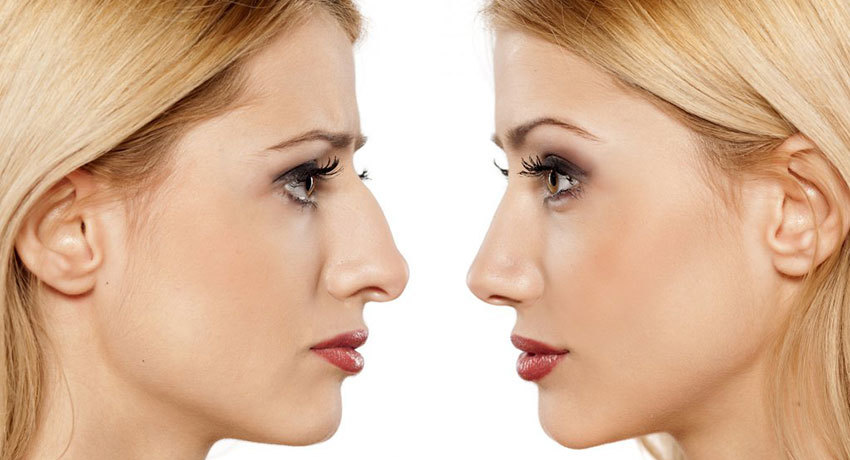 Ринопластика